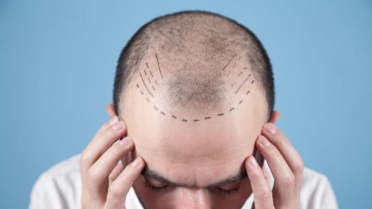How much does a hair transplant cost in Pittsburgh?